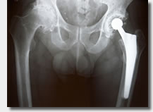 Xray of Hip Replacement